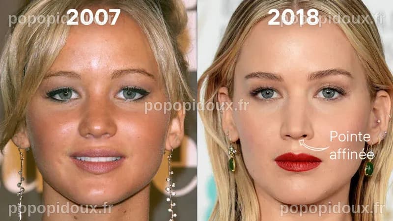 Jennifer Lawrence et la chirurgie esthétique