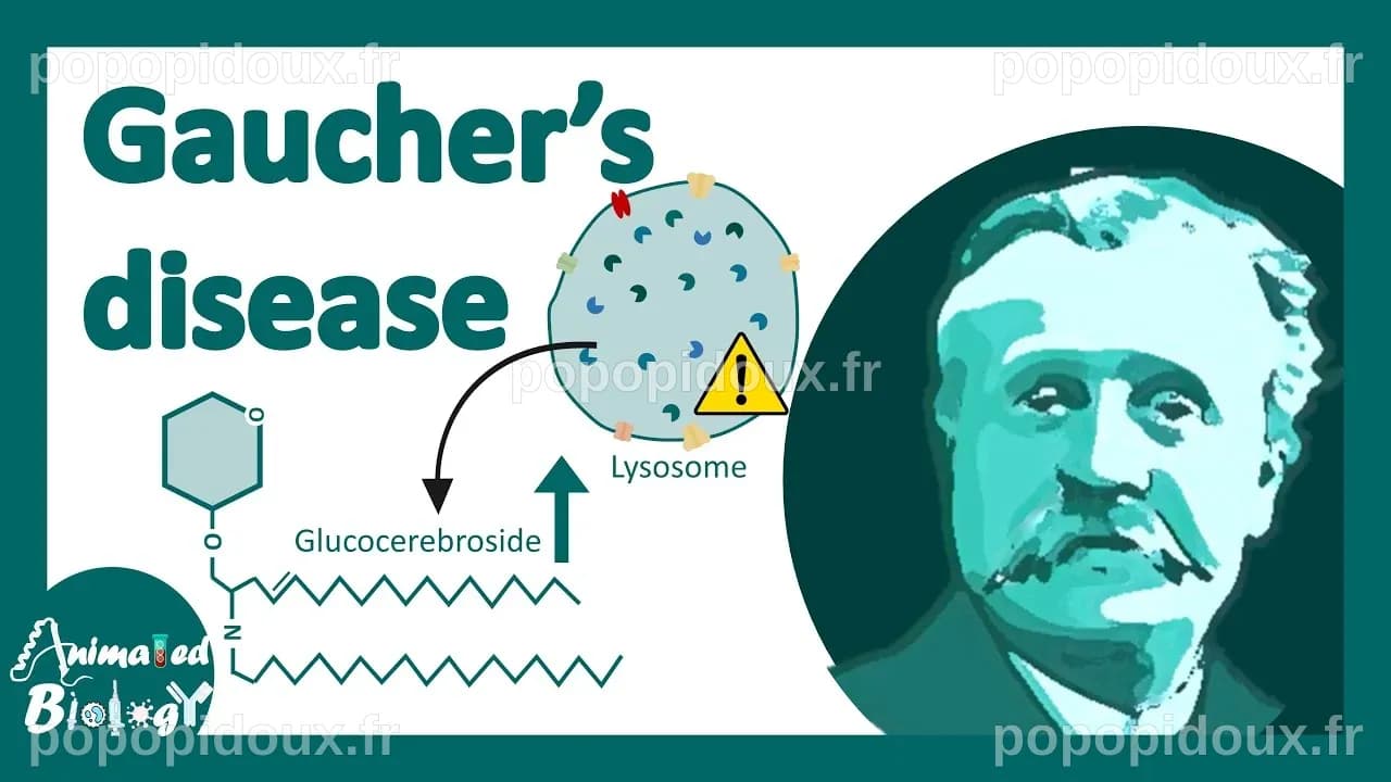 Gaucher's disease | classification, symptoms, pathology of Gaucher's ...
